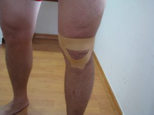 taping-for-fat-pad-1