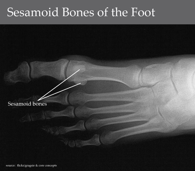 Sesamoiditis