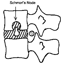 ScheuermannKyphosis