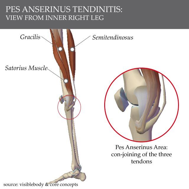 Pes Ancerinus腱炎