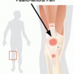 髌骨股痛综合征