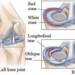 膝盖软骨的眼泪